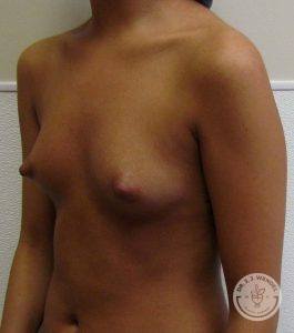 Saline Breast Implants