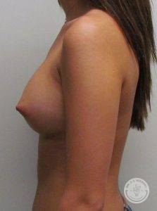 Saline Breast Implants