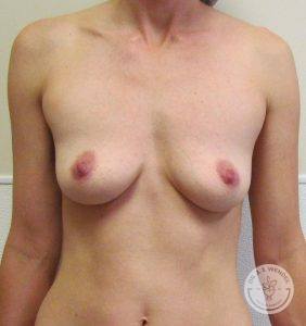 Silicone breast implant surgery Nashville Tennessee