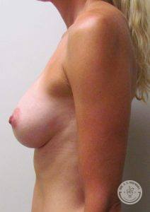 Silicone breast implant surgery Nashville Tennessee