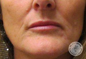 Woman Lip Augmentation after Nashville