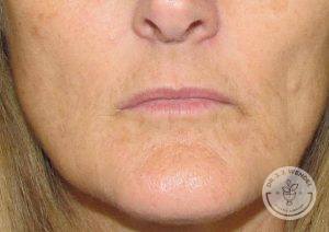 Woman Lip Augmentation before Nashville