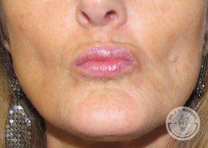 Woman after Lip Augmentation Nashville