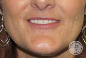 Woman after Lip Augmentation Nashville