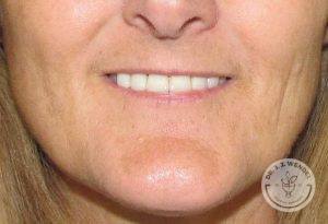 Woman before Lip Augmentation Nashville