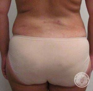 Woman after liposuction Nashville