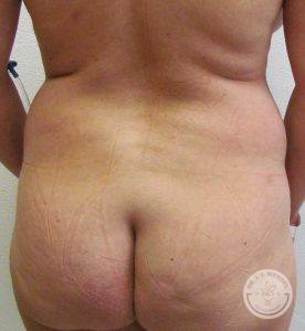 Woman before liposuction Nashville