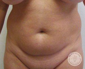 Woman before liposuction Nashville