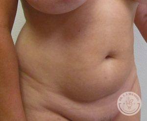 Woman before liposuction Nashville