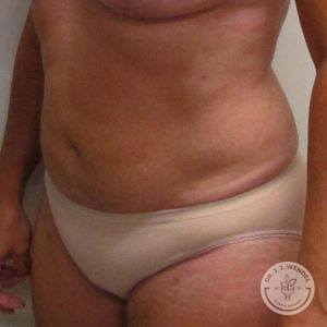 Woman after liposuction Nashville