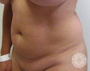Woman before liposuction Nashville