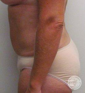 Woman after liposuction Nashville