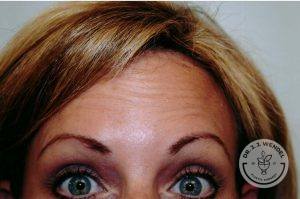 Woman before after Botox