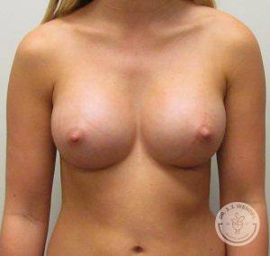 Before and After breast implants Nashville