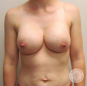 Silicone breast implant surgery Nashville Tennessee