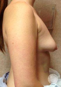 Woman before breast implants Nashville