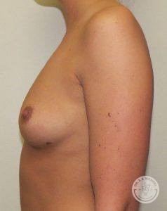 Silicone gel breast implants Nashville