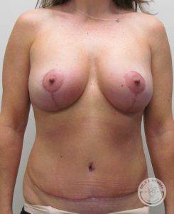 Breast Implant Revision Nashville
