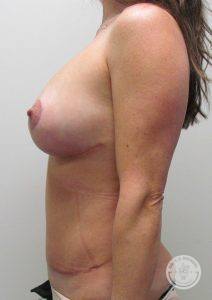Breast Implant Revision Nashville
