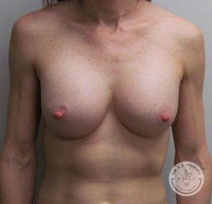 Silicone gel breast implants Nashville