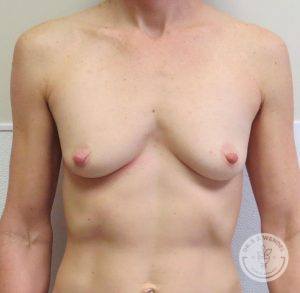 Silicone gel breast implants Nashville