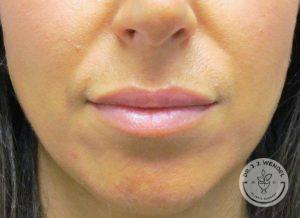 Woman after lip augmentation Nashville