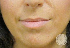 Woman before lip augmentation Nashville