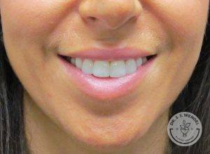 Woman after lip augmentation Nashville