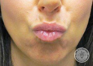 Woman after lip augmentation Nashville