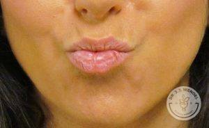 Woman before lip augmentation Nashville