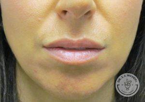 Woman after lip augmentation Nashville