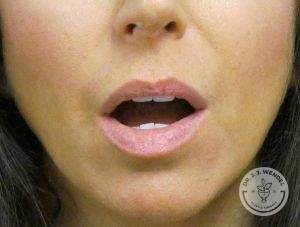 Woman before lip augmentation Nashville