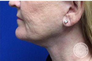 Woman after Kybella Nashville