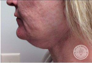 Woman before Kybella Nashville