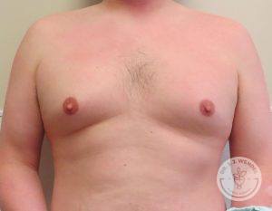 Breast Reduction for Men