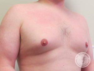 Breast Reduction for Men