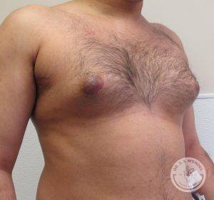 Breast Reduction for Men Nashville