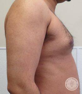 Breast Reduction for Men Nashville