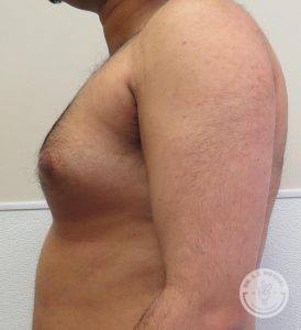 Breast Reduction for Men Nashville