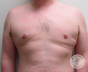 Breast Reduction for Men