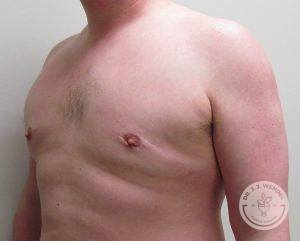 Breast Reduction for Men