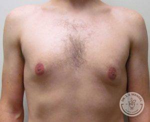 Breast Reduction for Men Nashville