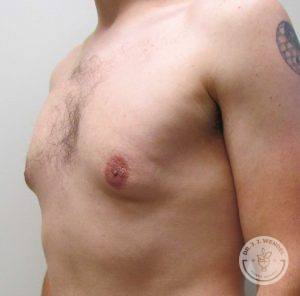 Male Breast Reduction Nashville