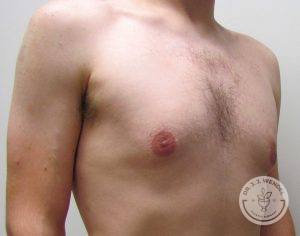 Male Breast Reduction Nashville