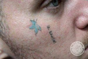 face tattoo removal nashville tn