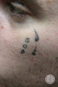 face tattoo removal nashville