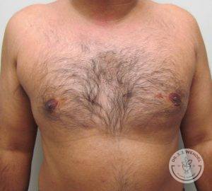 Breast Reduction for Men Nashville