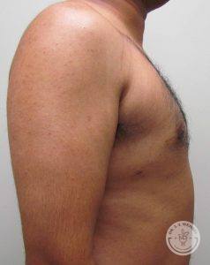 Breast Reduction for Men Nashville