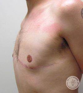 Male Breast Reduction Nashville