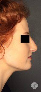 side profile of woman after nonsurgical nose job